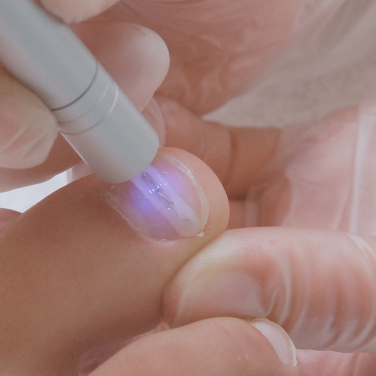 Micro lampe pour gel de scellement UV PediGel - Podofix